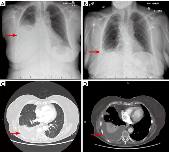 Acupuncture for pleural effusion in lung cancer